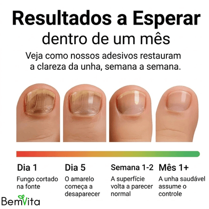 VitaUnha™ - Adesivos Tratamento para Fungos e Micose nas Unhas